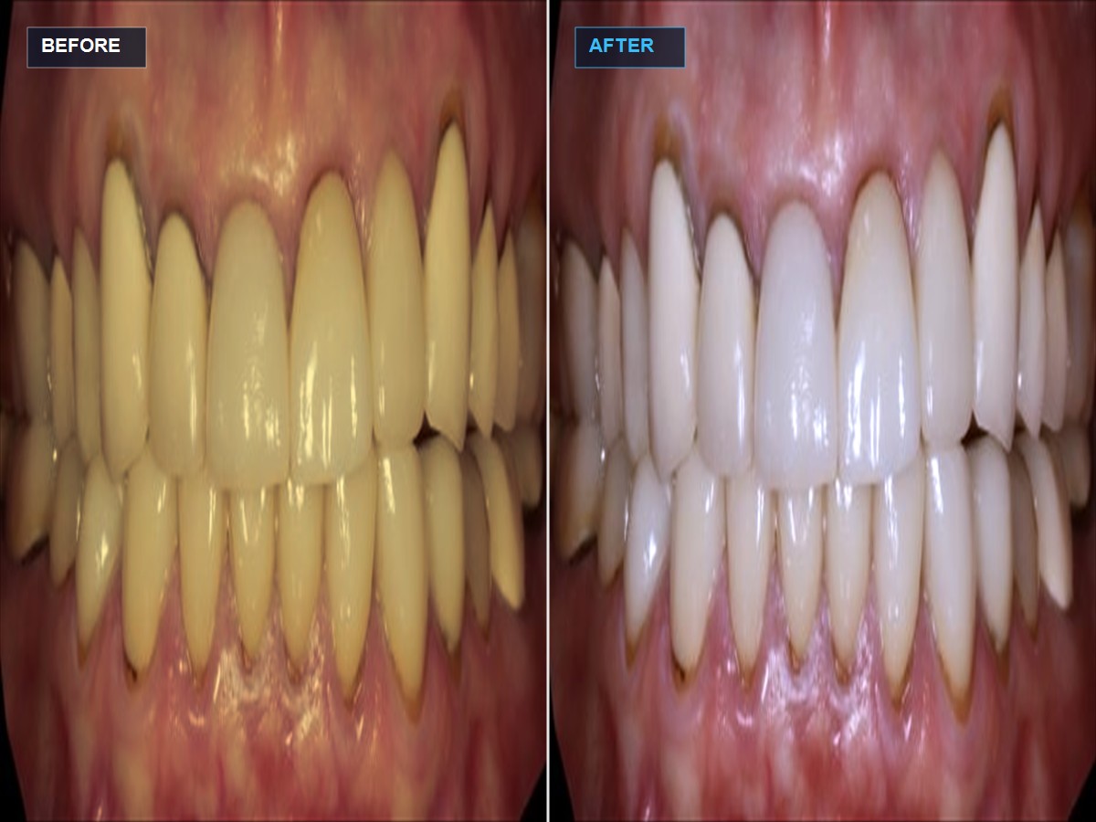 Professional teeth whitening before and after results at Dental Care Khagaria